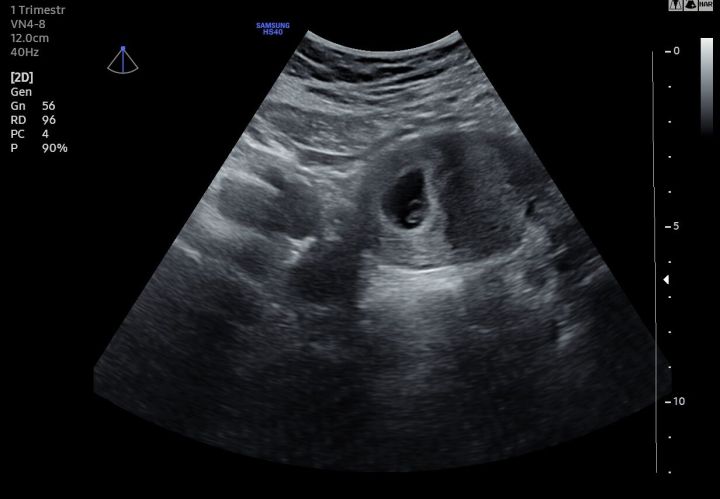 Semana 6 de embarazo: ya puedes escuchar el latido de tu bebé en la  ecografía