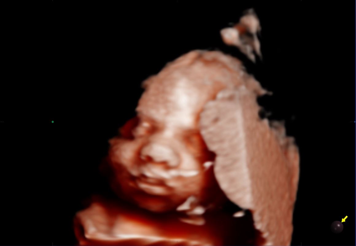 Latido fetal a las 5 semanas de embarazo - WELCOME BABY